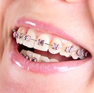 Ceramic Braces In La Crete, AB