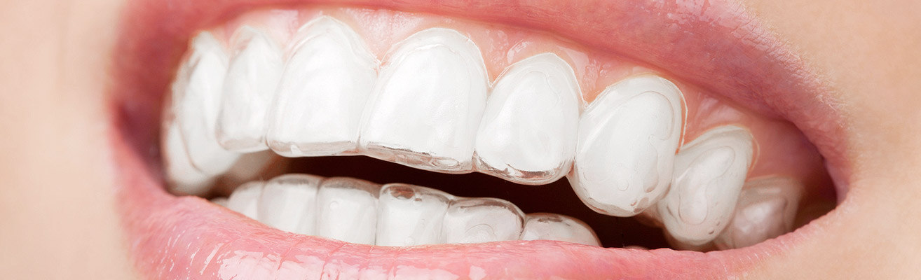 Clear Aligners (Spark and Invisalign) header clearaligners
