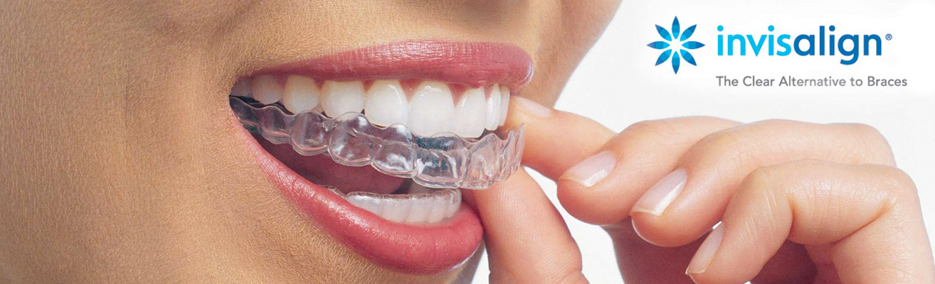 Invisalign header invisalign