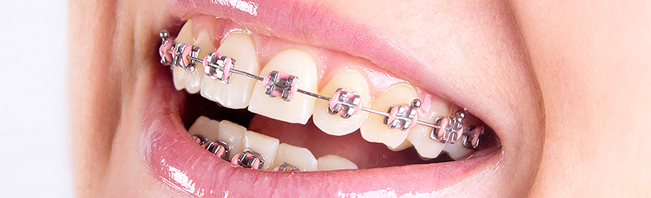 What Rubber Band Colors Say About You! - Braces in CA