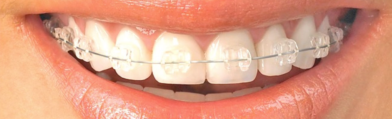ICE Brackets header radiancebrackets