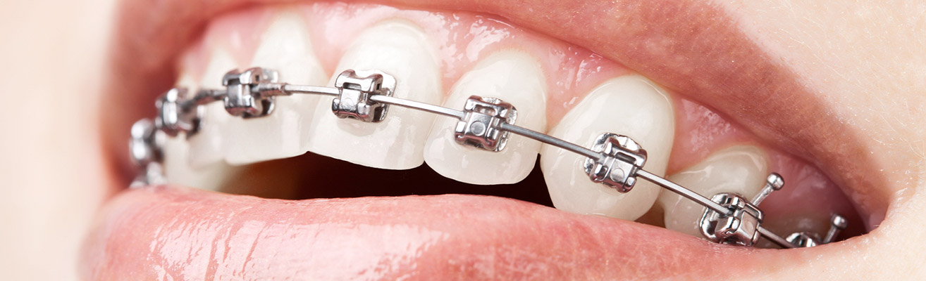 Self Ligating Braces Chino Hills La Habra Gire Orthodontics Self Ligating Braces Chino Hills La Habra Gire Orthodontics
