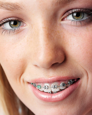 img metalbraces