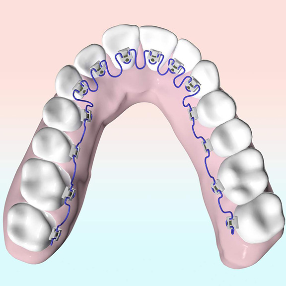 inbrace dental braces