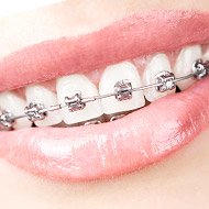 Clear Braces Manteca CA - Invisible Aligners - Teeth Straightening