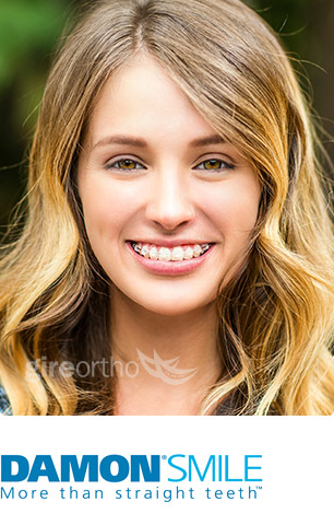 Damon® Smile FAQs img 011 damon1