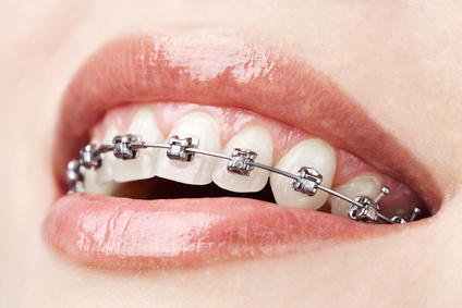 Invisalign vs Braces – We reveal the truth about how they compare