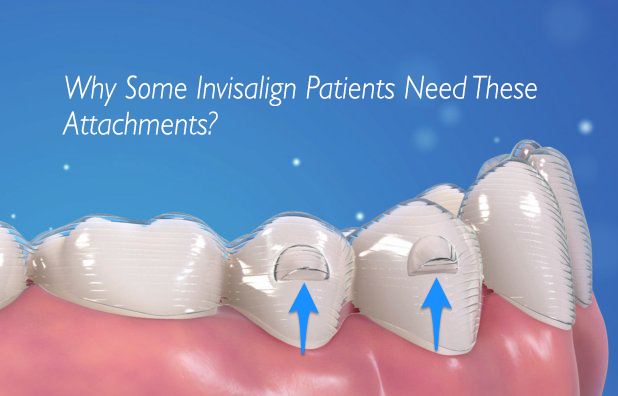 What Do They Put on Your Teeth for Invisalign: Unveiled Secrets