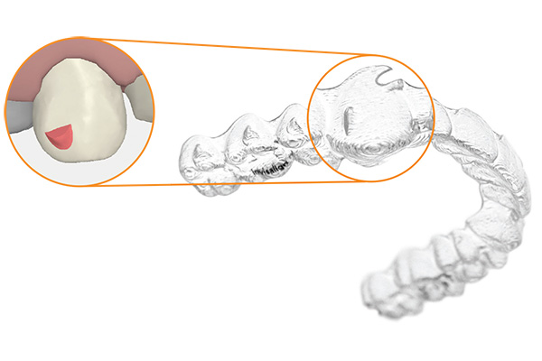 Invisalign precision cuts