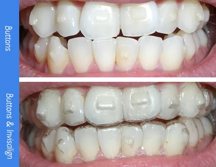 What are Invisalign attachments and why you might need one?