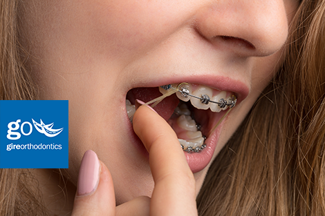 Learn More About Why Elastics Are Needed for Orthodontic Patients