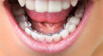 lingual braces behind the teeth