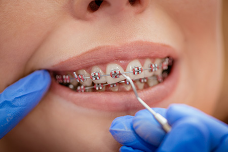 putting on braces