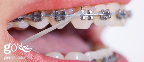 braces with elastics