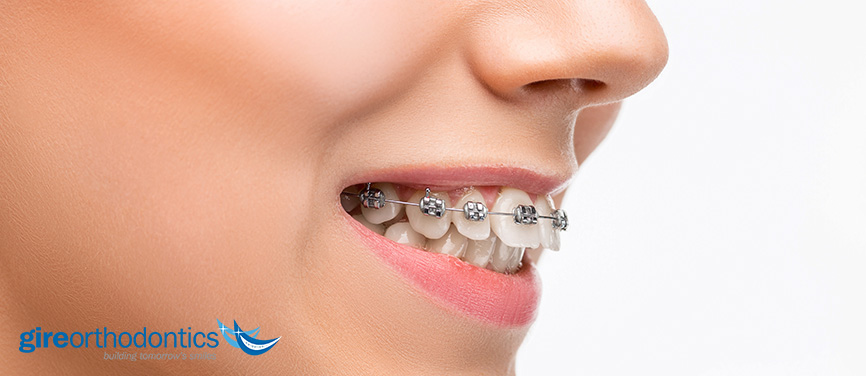 Overbite store braces time