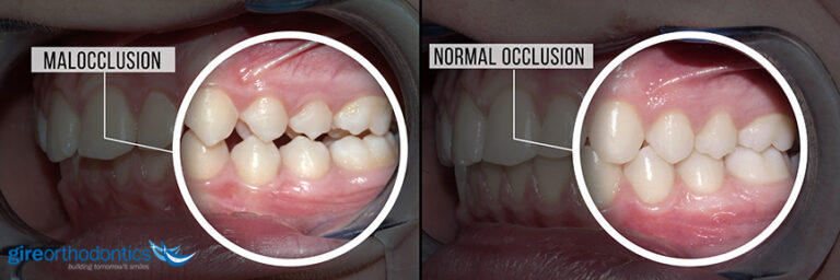 What is a Malocclusion?
