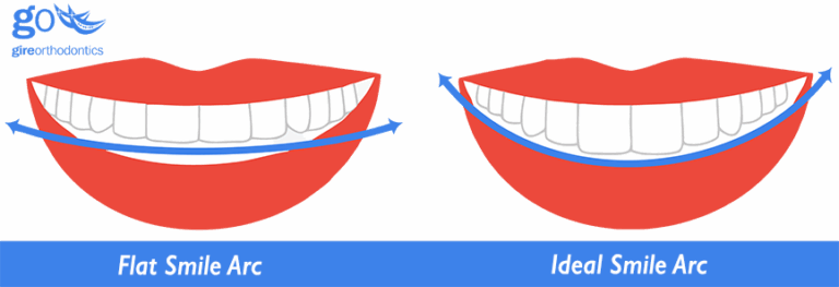 Why Are Those Braces Placed So Close To The Gums?