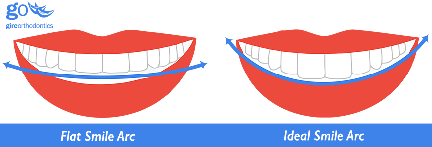 Can Higher Bracket Placement Create Better Smile Arc?