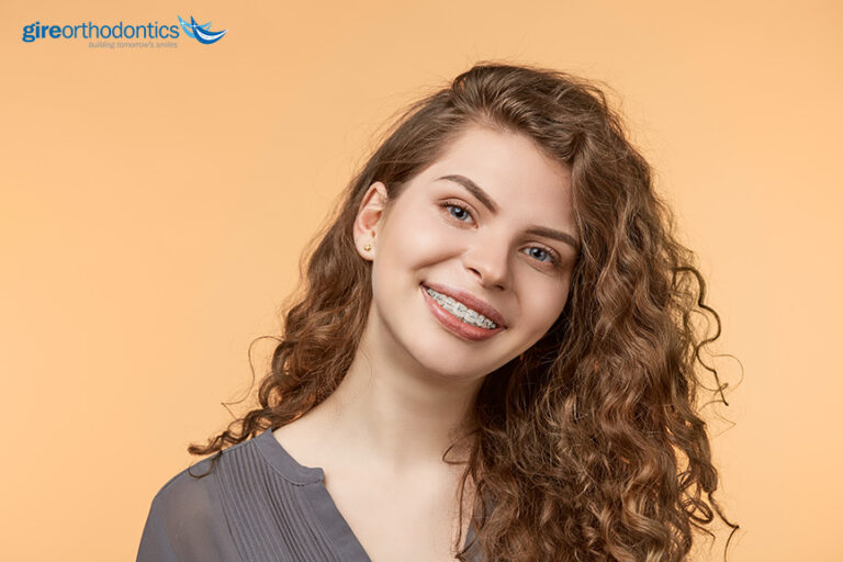Which Type of Braces are Right for You?