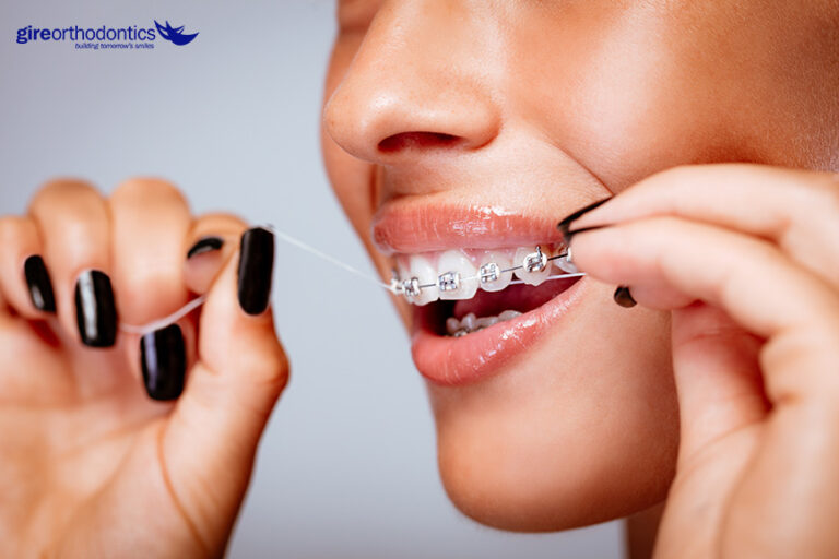Top Tips for Your Braces Care