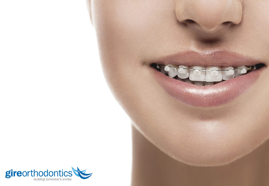 What are Ceramic Braces?  Lutherville, MD Orthodontist