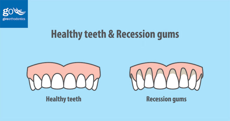Can Braces Cause Gum Recession?