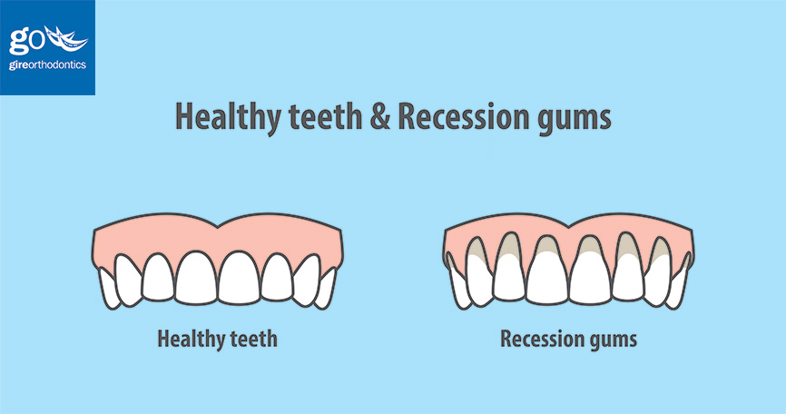 Gum Recession