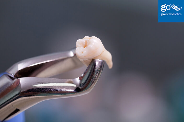 Are Tooth Extractions Necessary Before Braces?