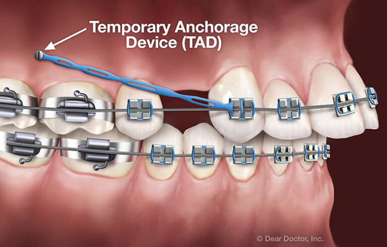 What Are Temporary Anchorage Devices?