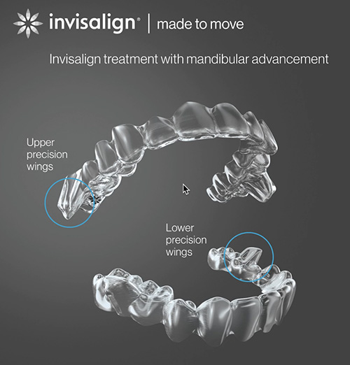 invisalign precision wings