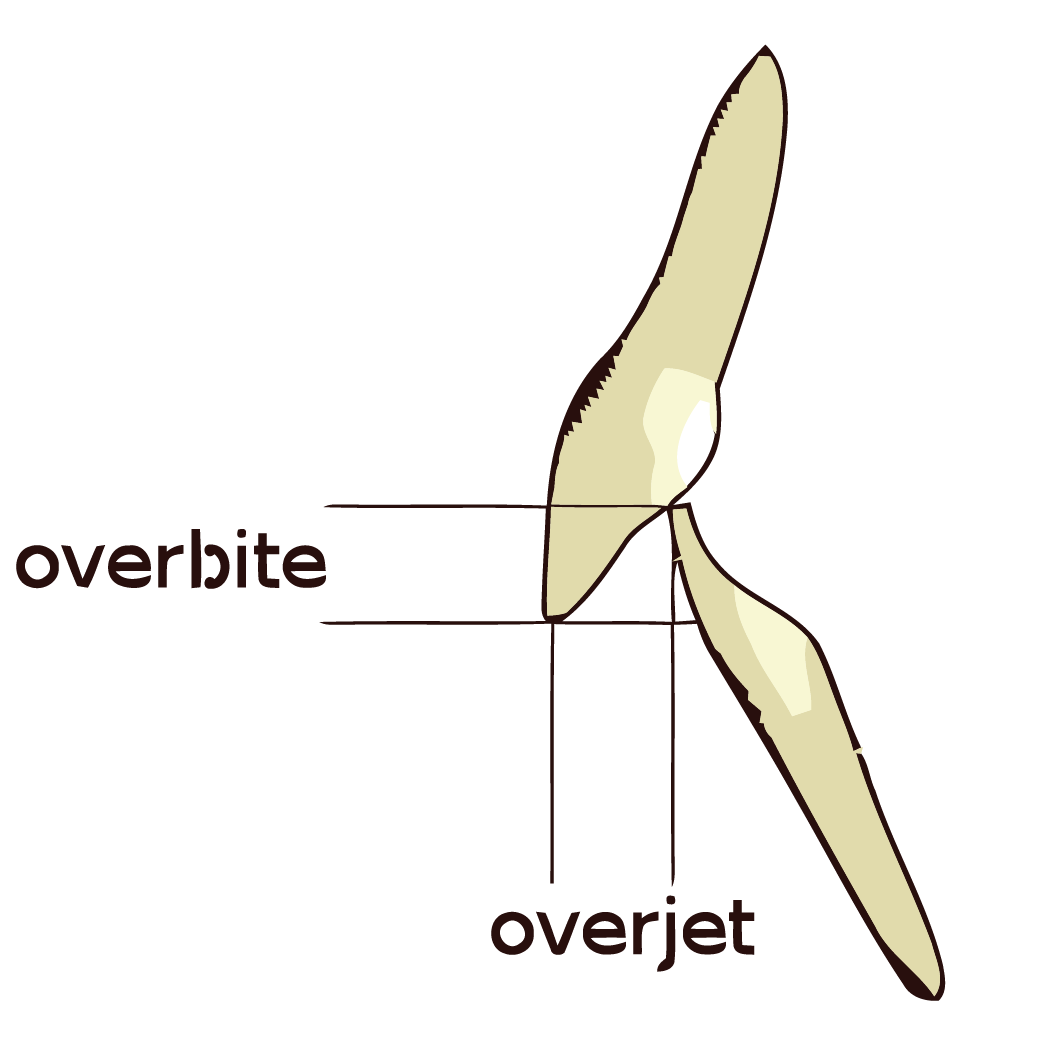 overbite vs overjet