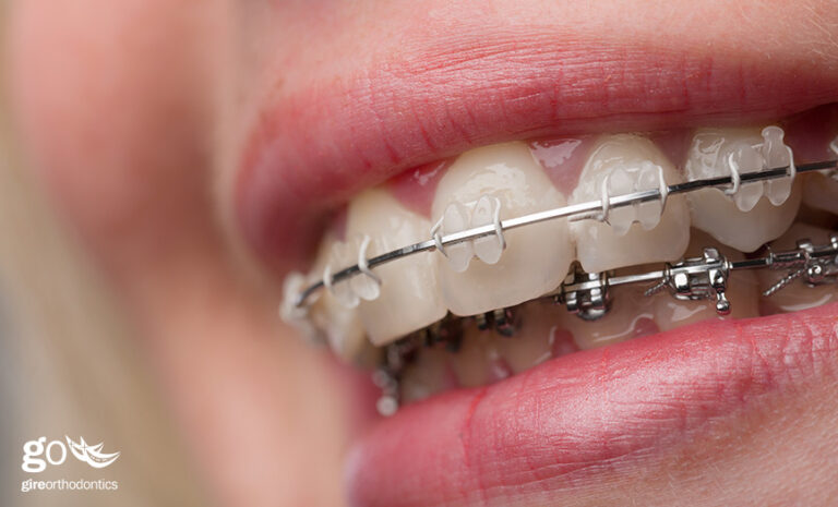 Mandibular Advancement Improves Bite and Facial Appearance