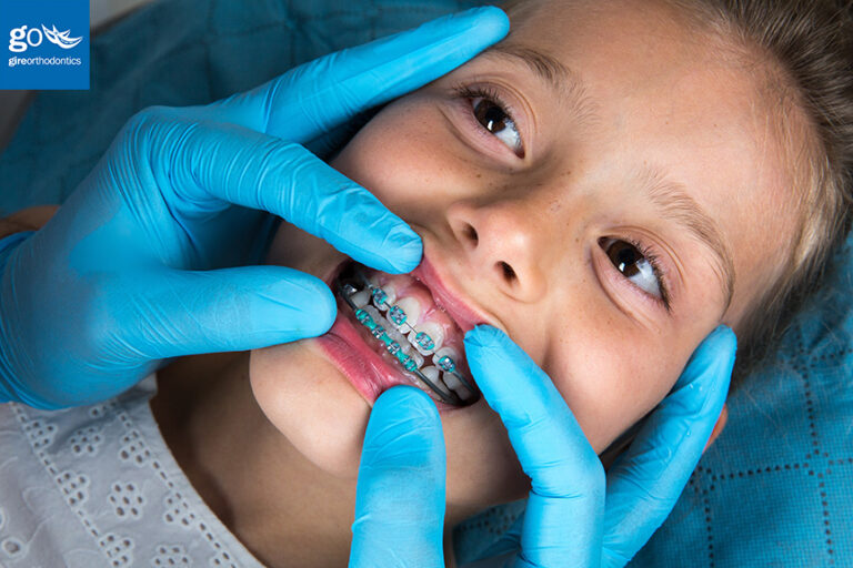 Orthodontic Treatment for Children With Special Needs
