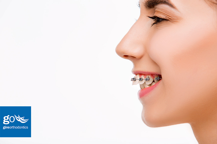 Learn More About Deep Bites and How to Correct Them