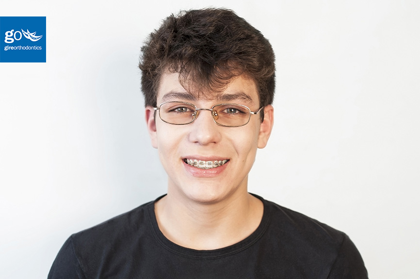 Are Braces Better Than Clear Aligners? metal braces 1