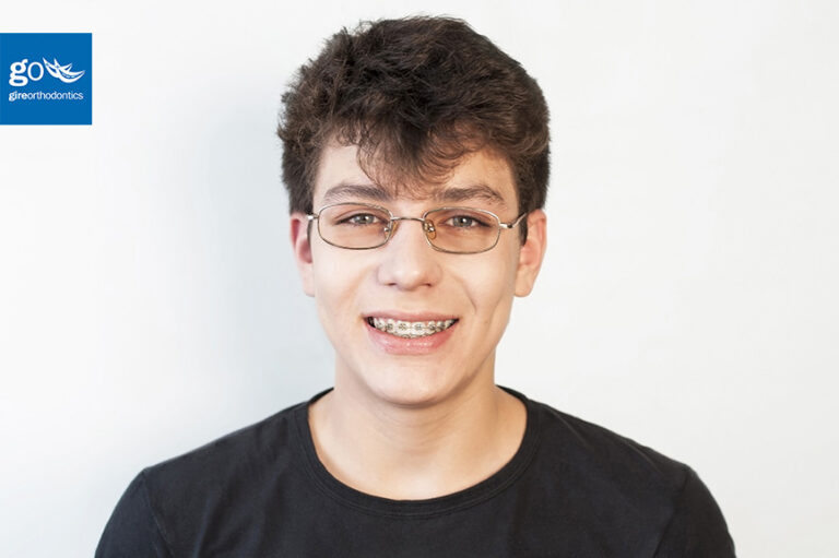 Are Braces Better Than Clear Aligners?