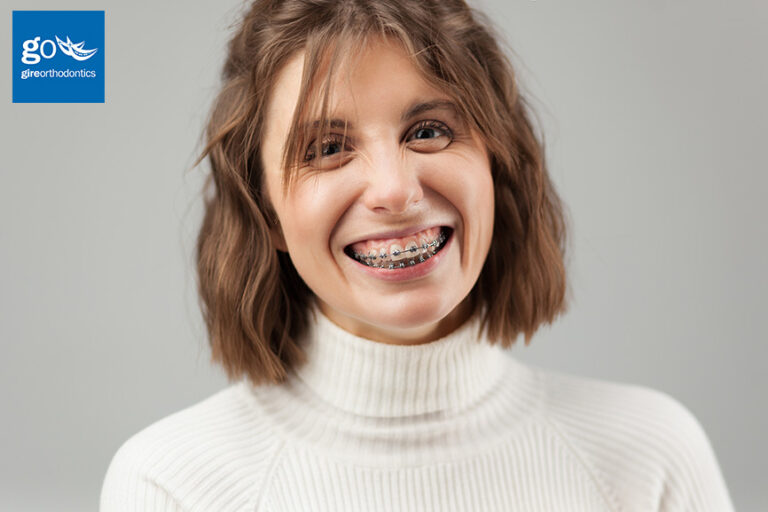 Braces for Adults with Implants, Crowns, or Other Restorative Work
