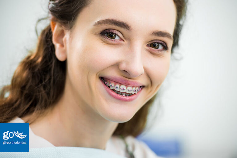 Can Braces Leave White Marks on Teeth?