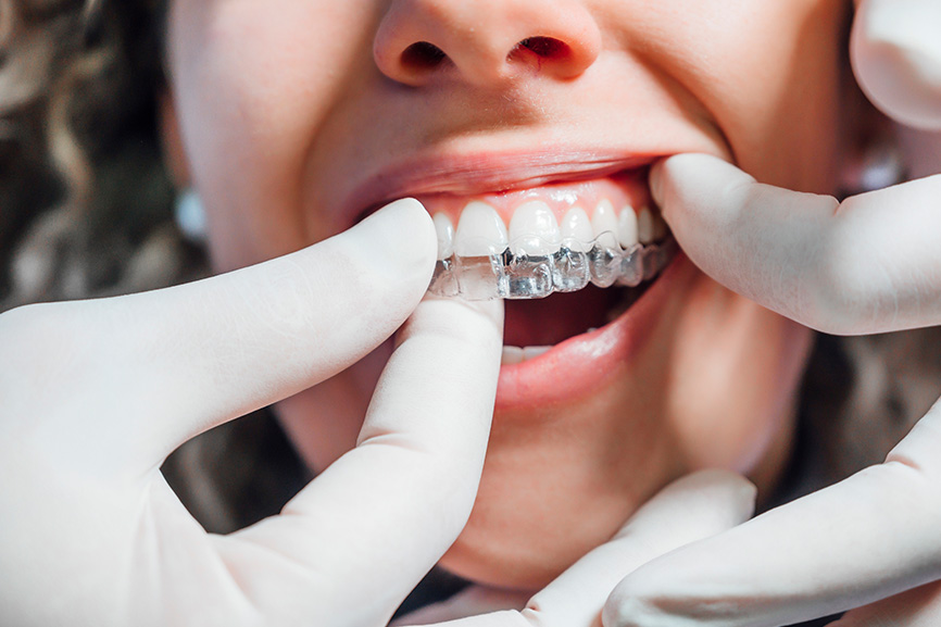 Answers to Ten of the Top Questions About Clear Aligner Therapy