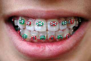 How important is wearing rubber bands with braces?