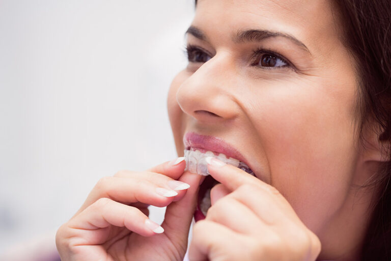How Can You Quickly Get Used to Wearing Clear Aligners?