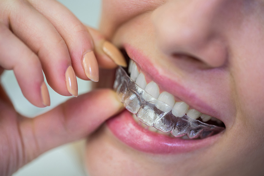 Why Can’t I Eat and Drink with My Aligners In? clear aligners chino hills