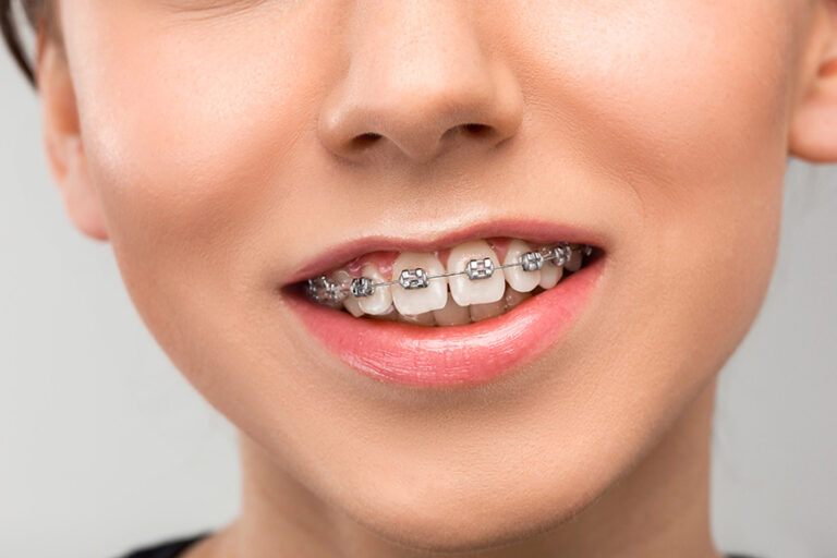 Four Tips to Speed Up Your Orthodontic Treatment