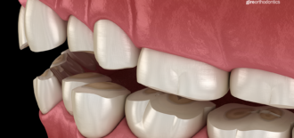 Can Orthodontic Treatment Curb Bruxism?