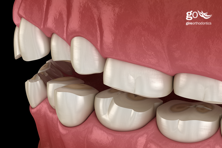 Will Your Braces Stop Your Teeth Grinding?