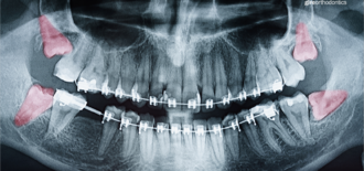 Will Wisdom Teeth Affect My Child’s Orthodontic Result?