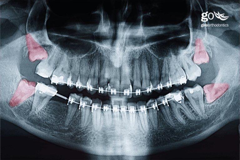 Will Wisdom Teeth Affect My Child’s Orthodontic Result?