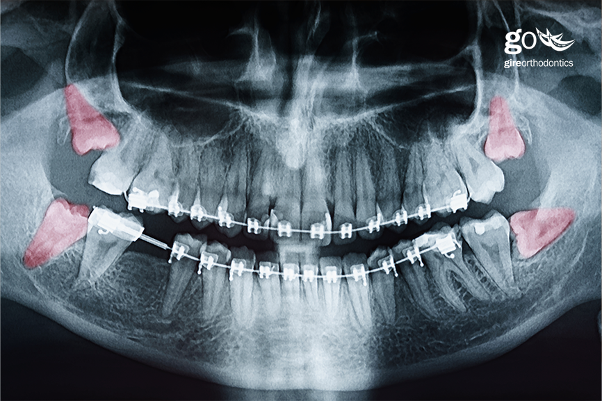 wisdom teeth affects orthodontics result