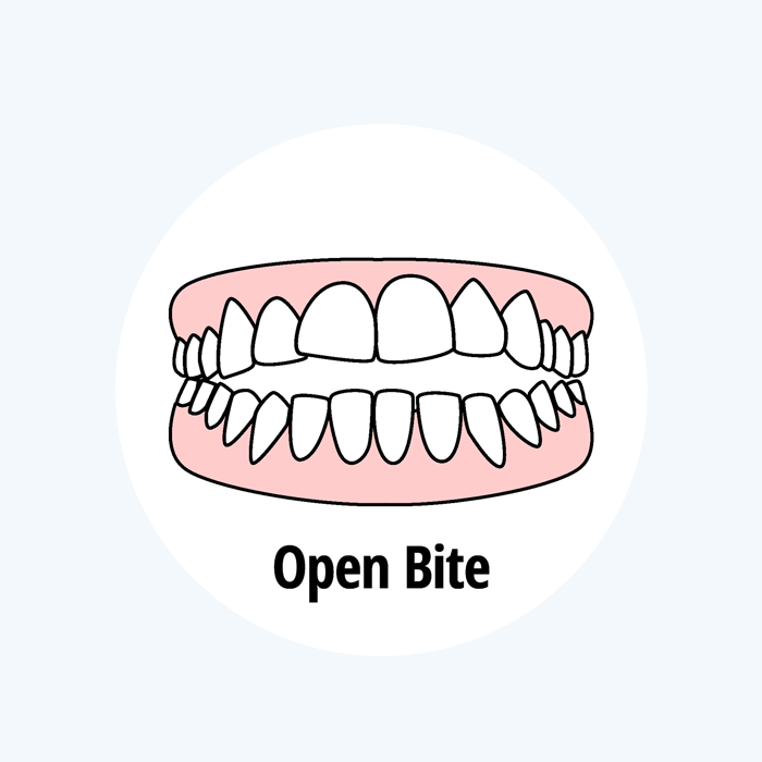open bite