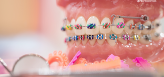 Does Dental Insurance Cover Orthodontic Treatment?
